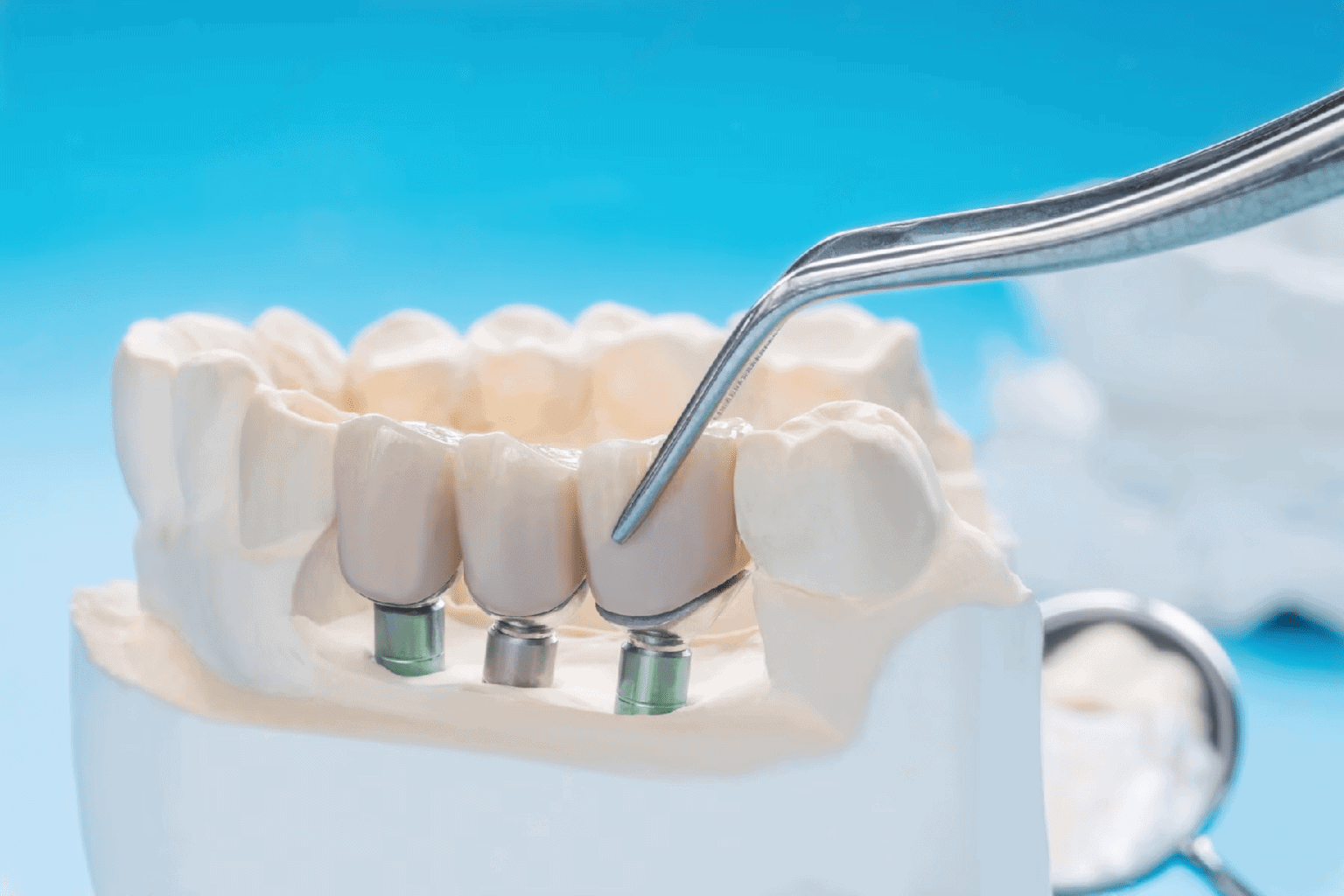 Several Missing Teeth - Kitcha Dental Clinic Chiang Mai