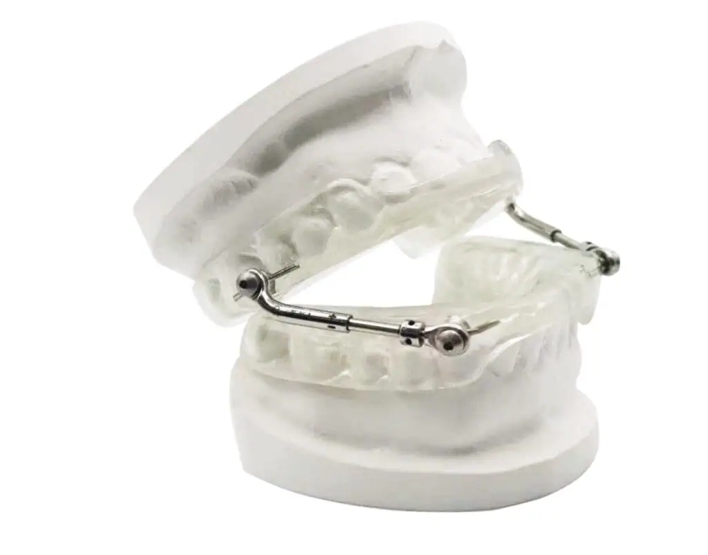 Orthodontic dental model with metal wire for braces treatment at Kitcha Dental Clinic Chiang Mai.
