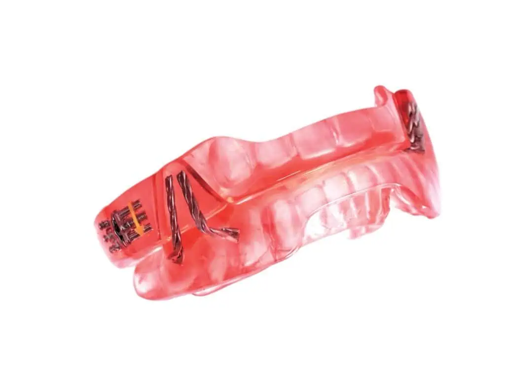 Flexible dental night guard mold with metal clasps for teeth protection from Kitcha Dental Clinic Chiang Mai.