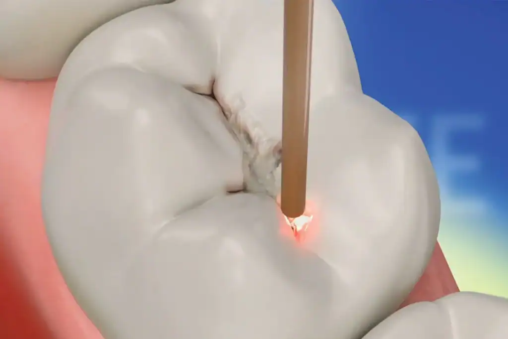 3D illustration of a laser tip with water spray removing decay from a back tooth