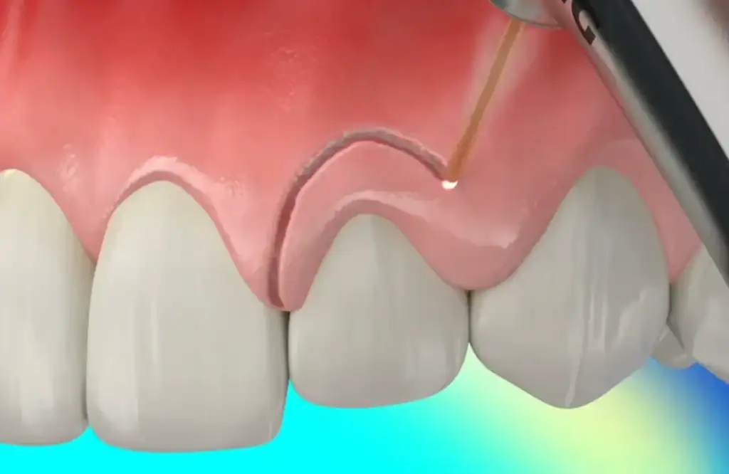 3D illustration of a laser tip trimming the gum line around a front tooth