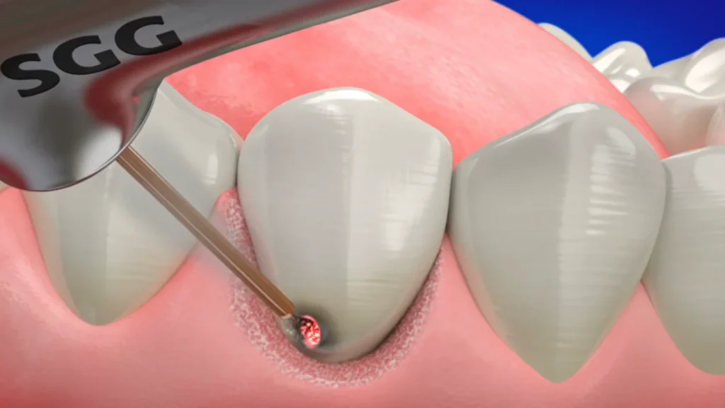 3D illustration of a Waterlase handpiece and tip removing decay near the gum line
