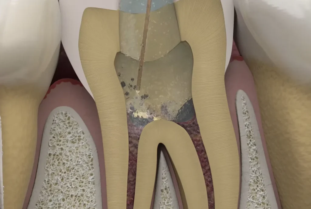 3D cross-section illustration of a laser tip inside the root canal of a molar