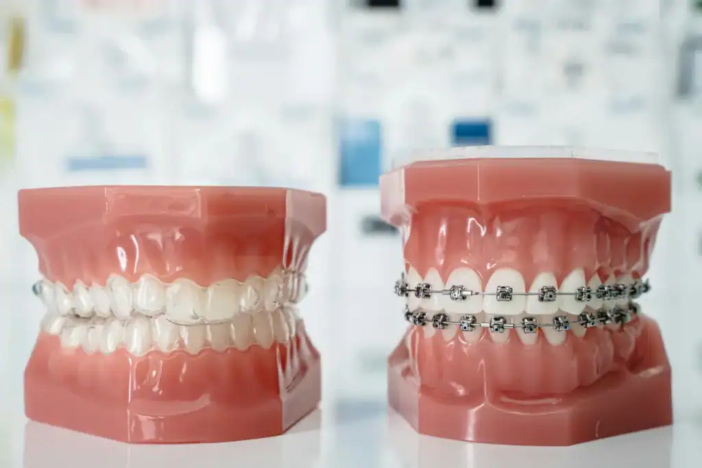 Two dental models, one with tooth-colored braces and one with metal braces