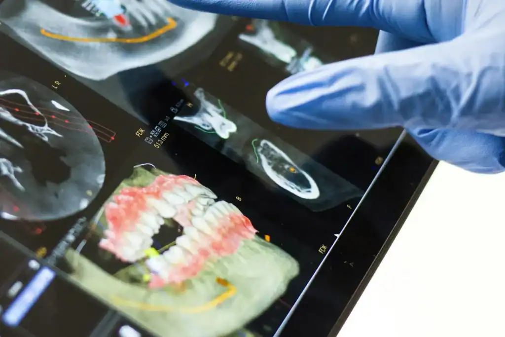 A gloved finger pointing at a 3D dental scan on a tablet