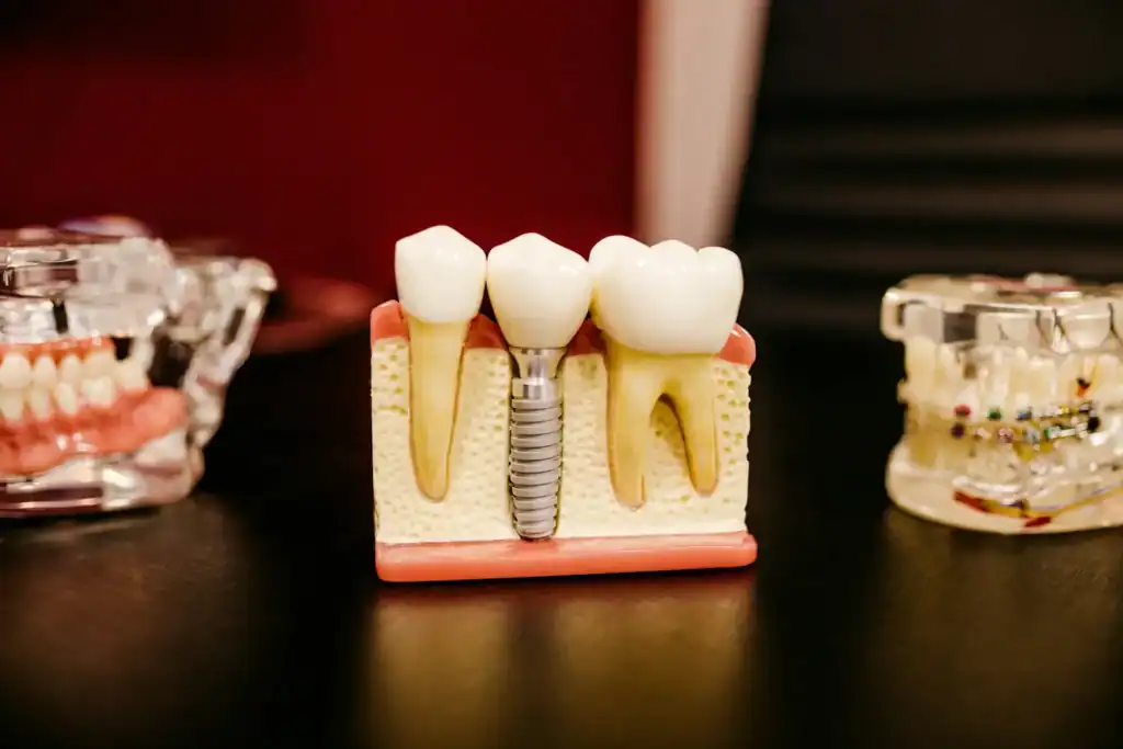 A dental implant teaching model between two teeth