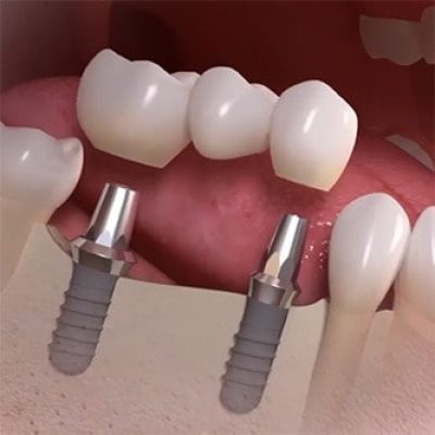 multiple-implant-bridge