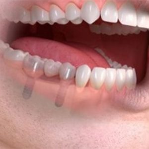 multiple-implants (1)