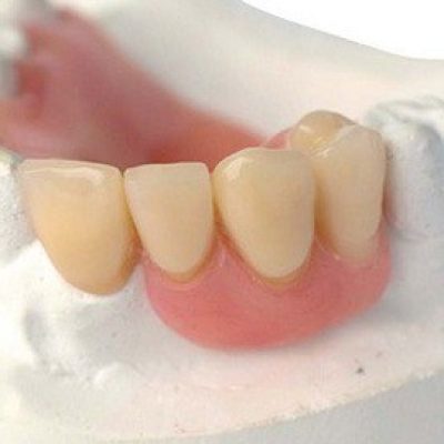 partial-dentures
