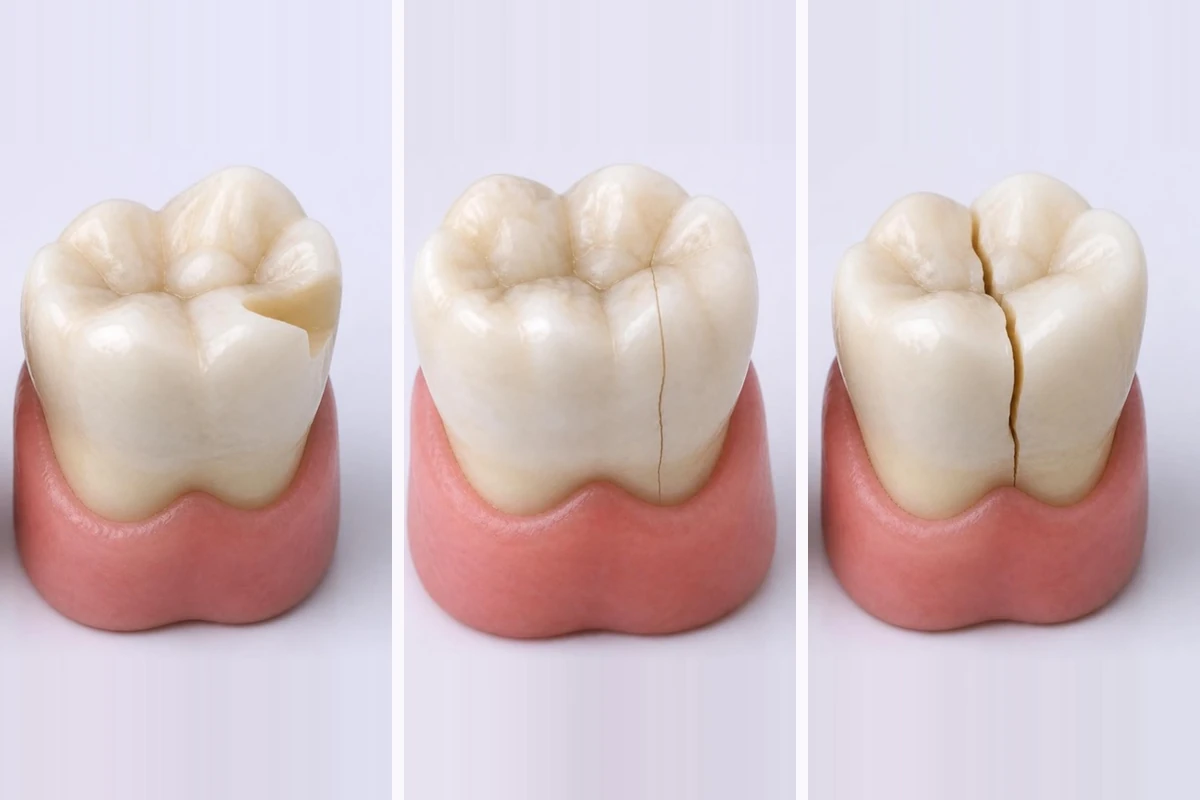 3D插图:并排的三颗后牙——左侧咬合面的一角折断,中间有一条细裂纹越过咬合面并沿牙冠侧面向下延伸,右侧有一条深裂纹把牙冠分成两部分