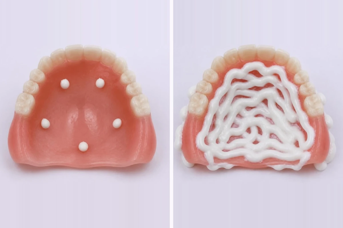3D插图:上颌义齿组织面的两种情况——几小点义齿黏合剂远离边缘,以及涂满整个面并溢出边缘的过量黏合剂