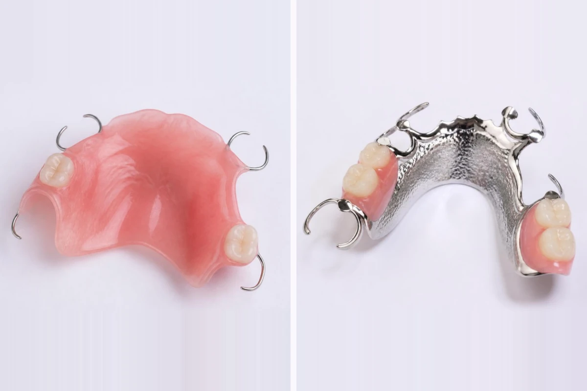 3D插图:两种上颌局部义齿——覆盖较多上腭、带钢丝卡环的临时粉色树脂义齿,以及有一块薄金属板横跨上腭、带铸造卡环的金属支架义齿