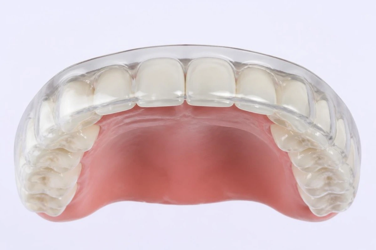 3D model of an upper dental arch seen from below, covered by a clear hard night guard (occlusal splint) that fits over all the teeth