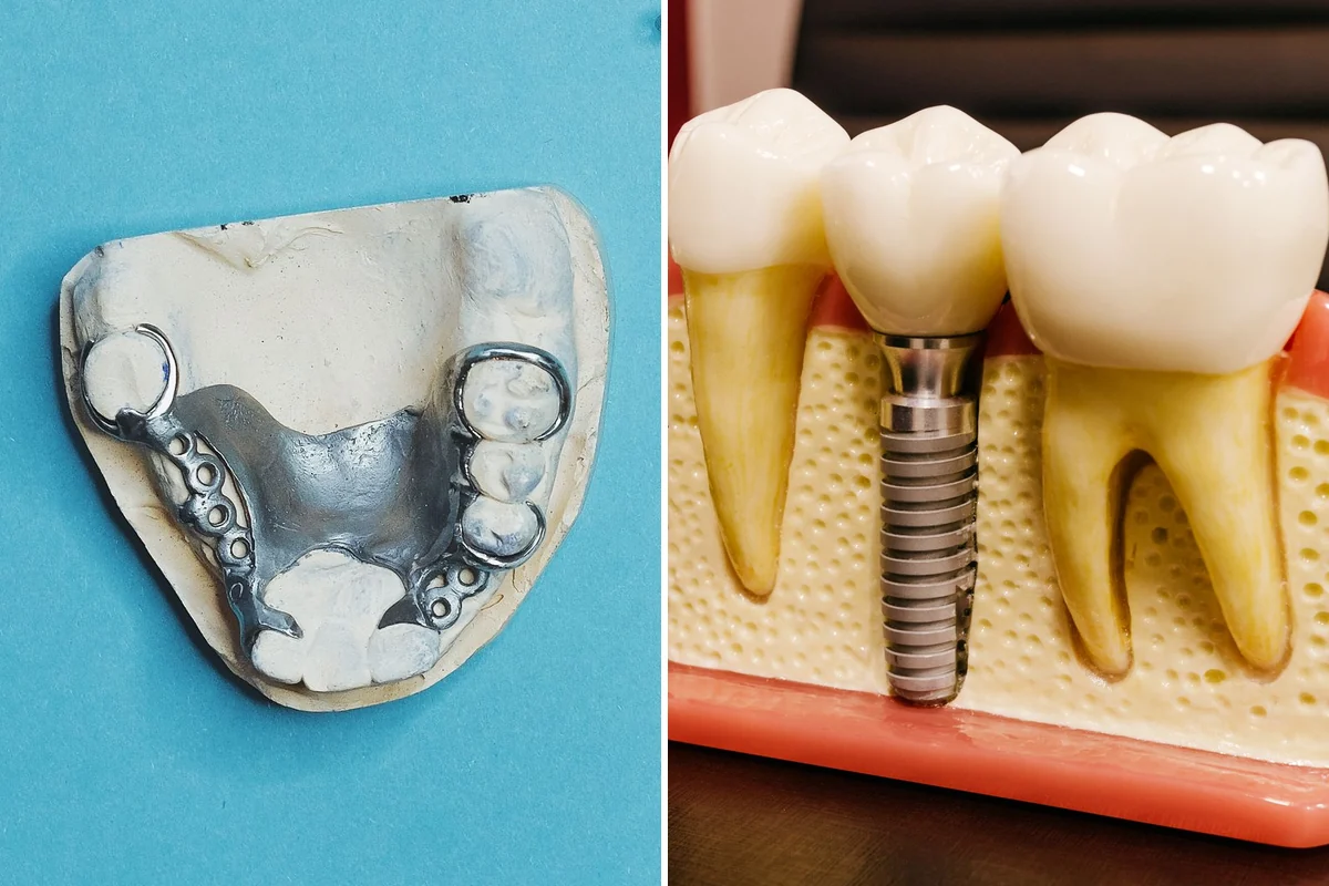 Two photos side by side: the metal framework of a removable partial denture on a plaster model, and a cut-away model of a single dental implant with a crown between two natural teeth