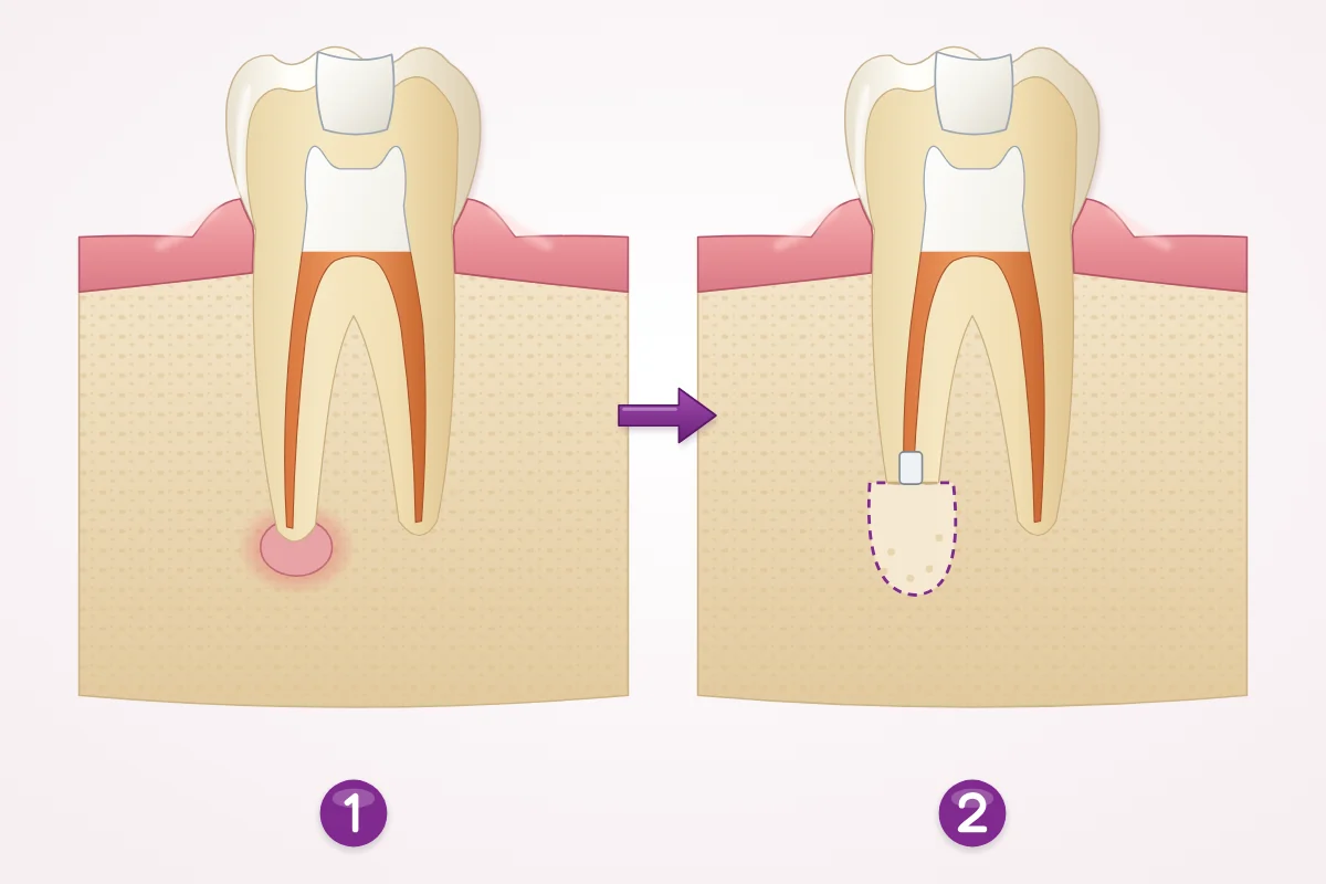 Illustration of a root-filled tooth with an infection at the root tip, then the root tip removed and sealed