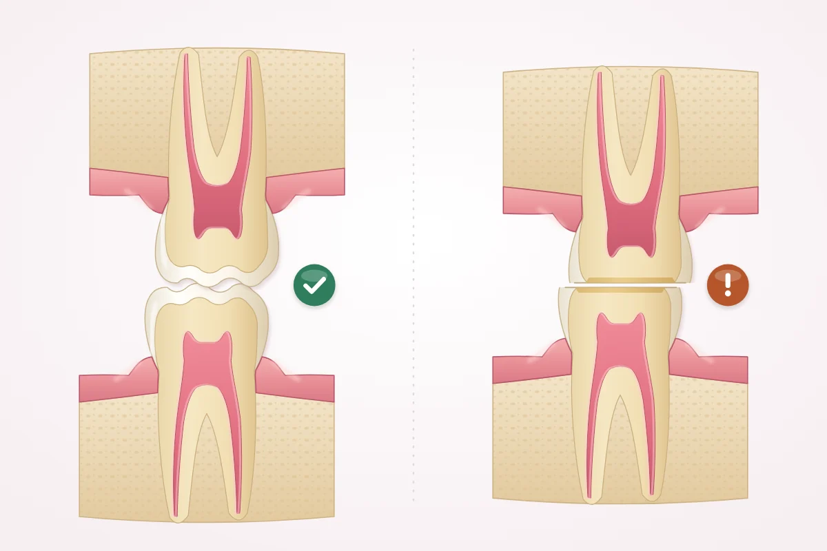 Illustration comparing upper and lower molars with normal cusps and molars worn flat by teeth grinding
