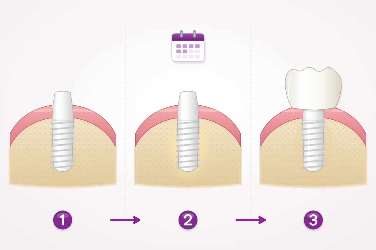 Illustration of ceramic implant treatment in three steps: the implant is placed, the bone heals around it for some months, then the crown is fitted
