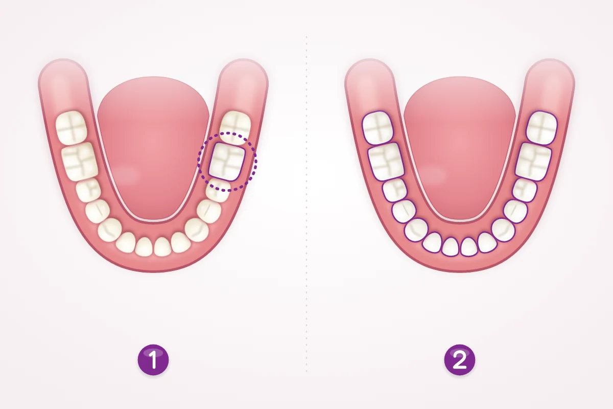 Illustration comparing restoring one tooth with restoring teeth across the whole arch