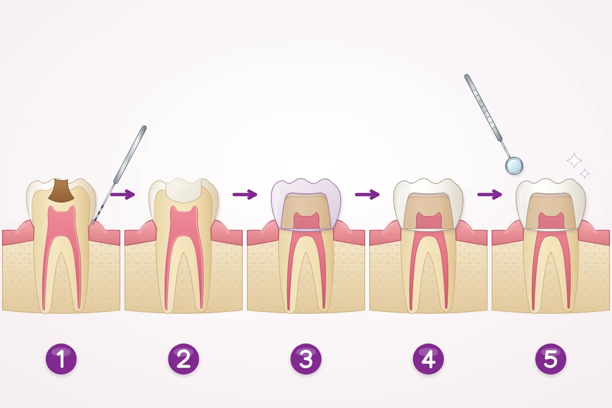 Five-step illustration of full mouth rehabilitation: examination and plan, gum and tooth care, temporary teeth, final restorations, regular check-ups