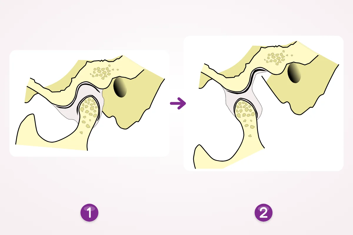 Jaw joint seen from the side: with the mouth closed the condyle sits in its socket under the disc, and with the mouth open the condyle and disc slide forward